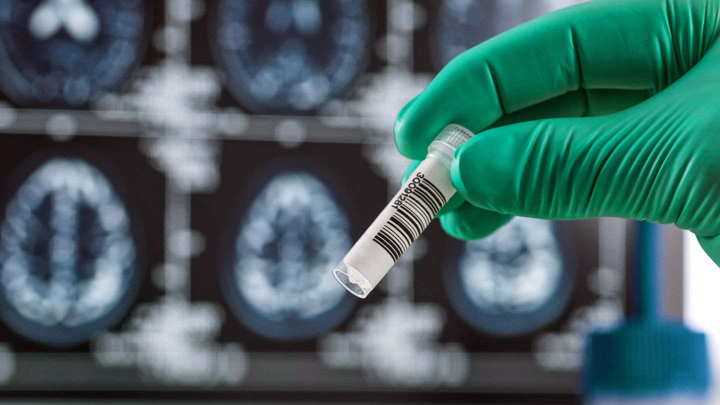 Un médicament expérimental contre la maladie d'Alzheimer ralentit le déclin cognitif