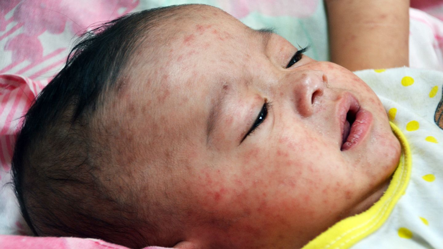 Une épidémie de rougeole dans l'Ohio menace les enfants