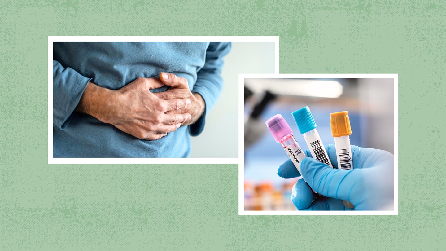 Quels sont les symptômes du cancer colorectal précoce ?