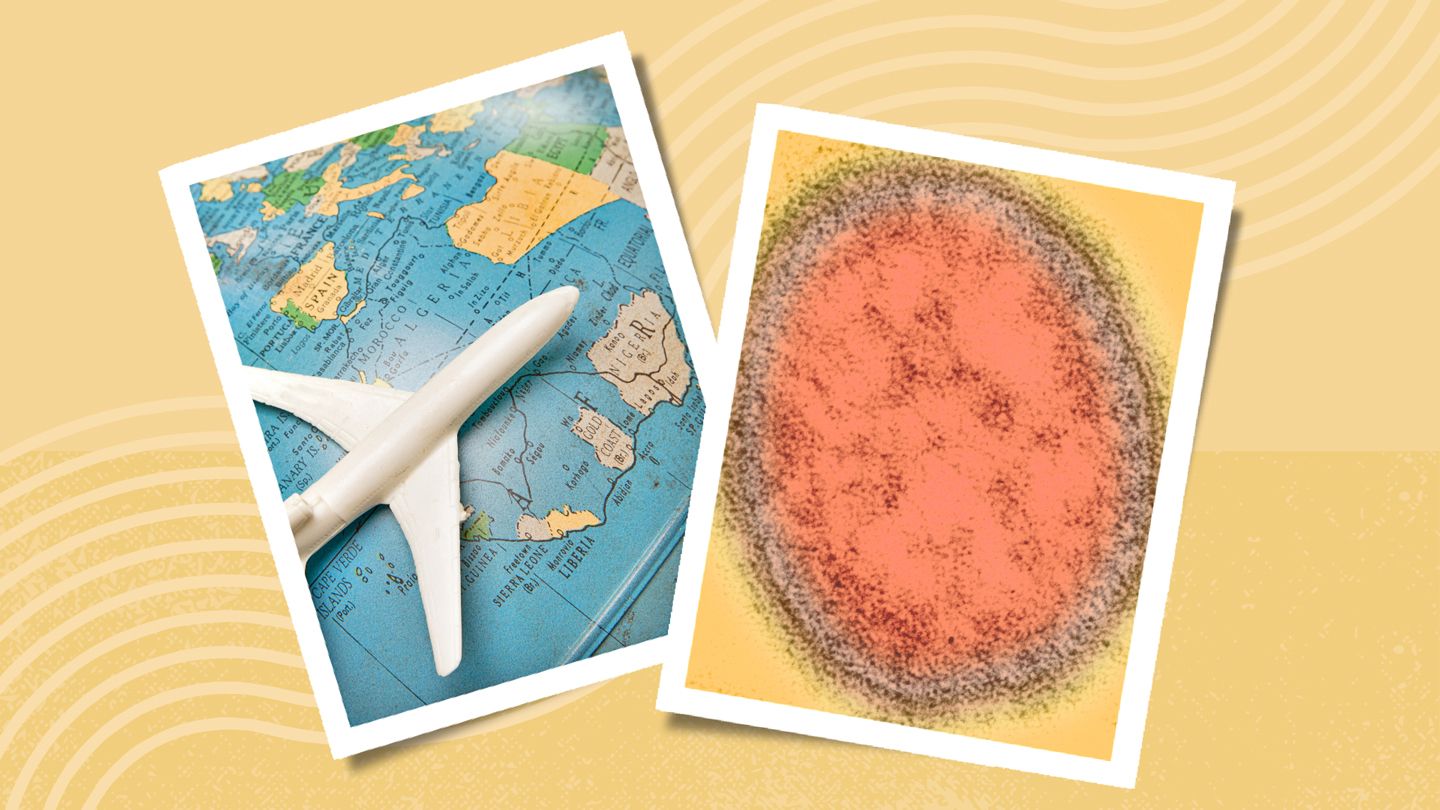 Le CDC avertit que les cas de rougeole sont en augmentation alors que la saison des voyages d'été commence