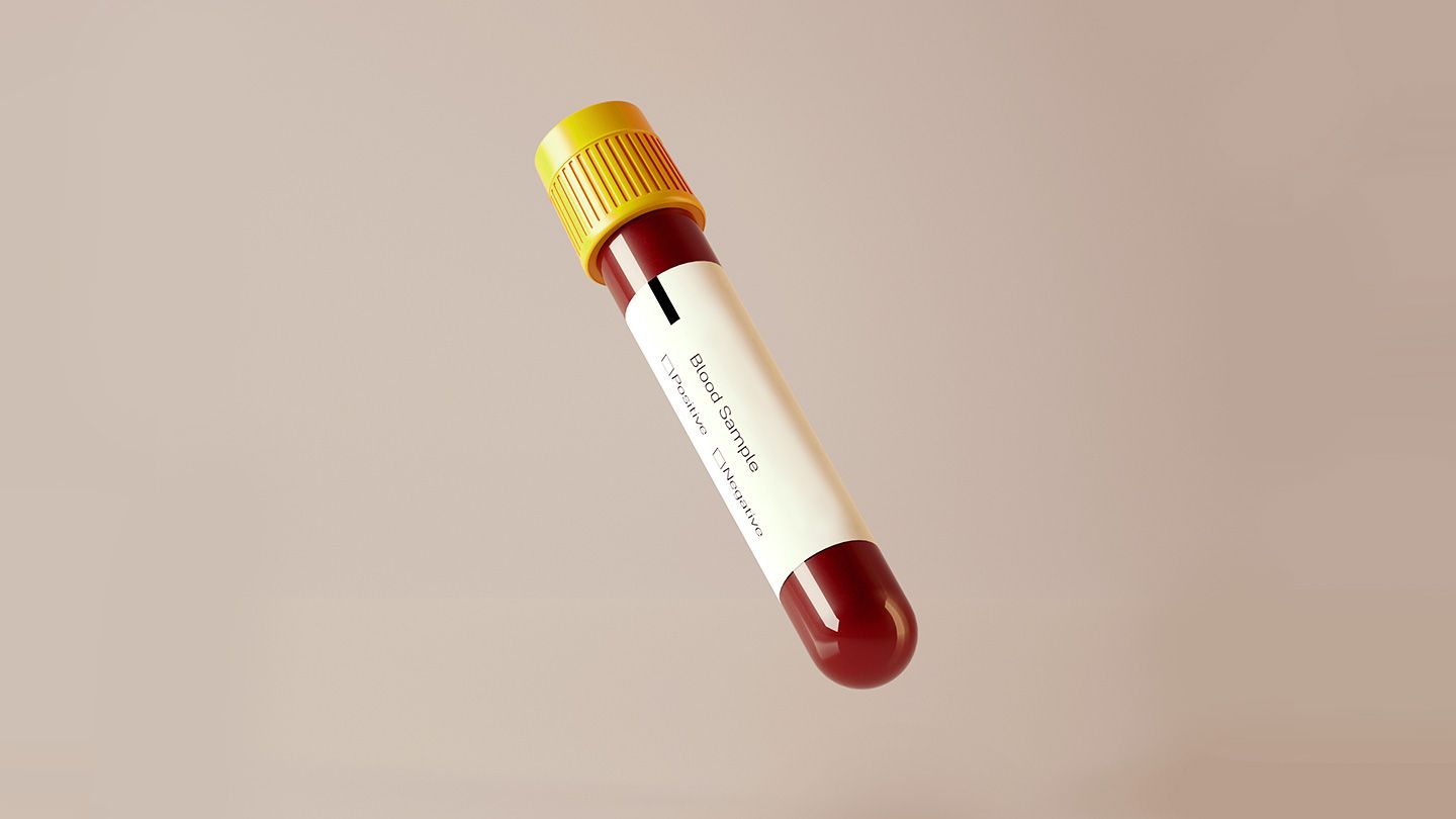 Un test sanguin pour diagnostiquer un long COVID pourrait être bientôt en route