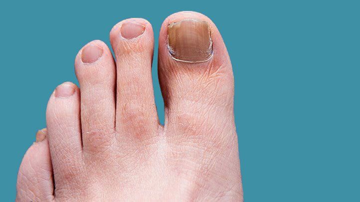 Comment éliminer les champignons des ongles et des pieds