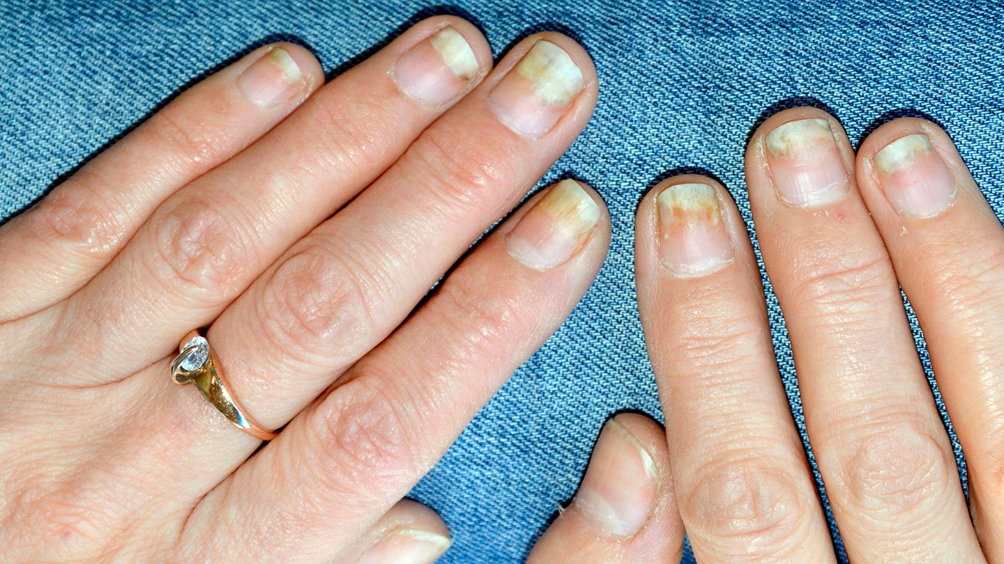 Dommages aux ongles causés par le rhumatisme psoriasique : symptômes et traitement