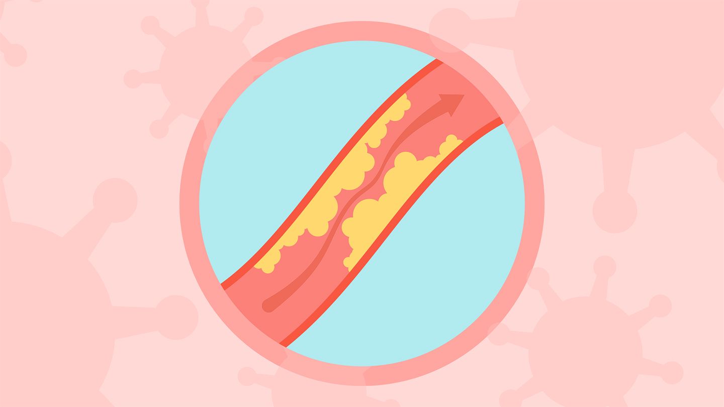 COVID-19 May Contribute to Clogged Arteries