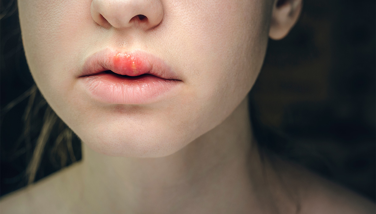 Angedème héréditaire, l'importance du diagnostic: symptômes et centres de soins