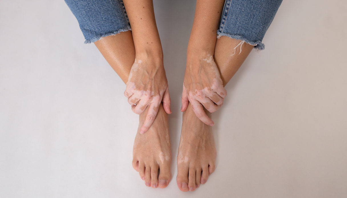 Vitiligo, gérez-le mieux et sachez-le pour aller au-delà des faux mythes