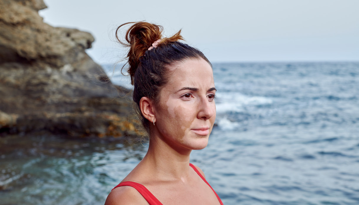 Vitiligo - pour vivre avec (mieux), au-delà des lieux communs