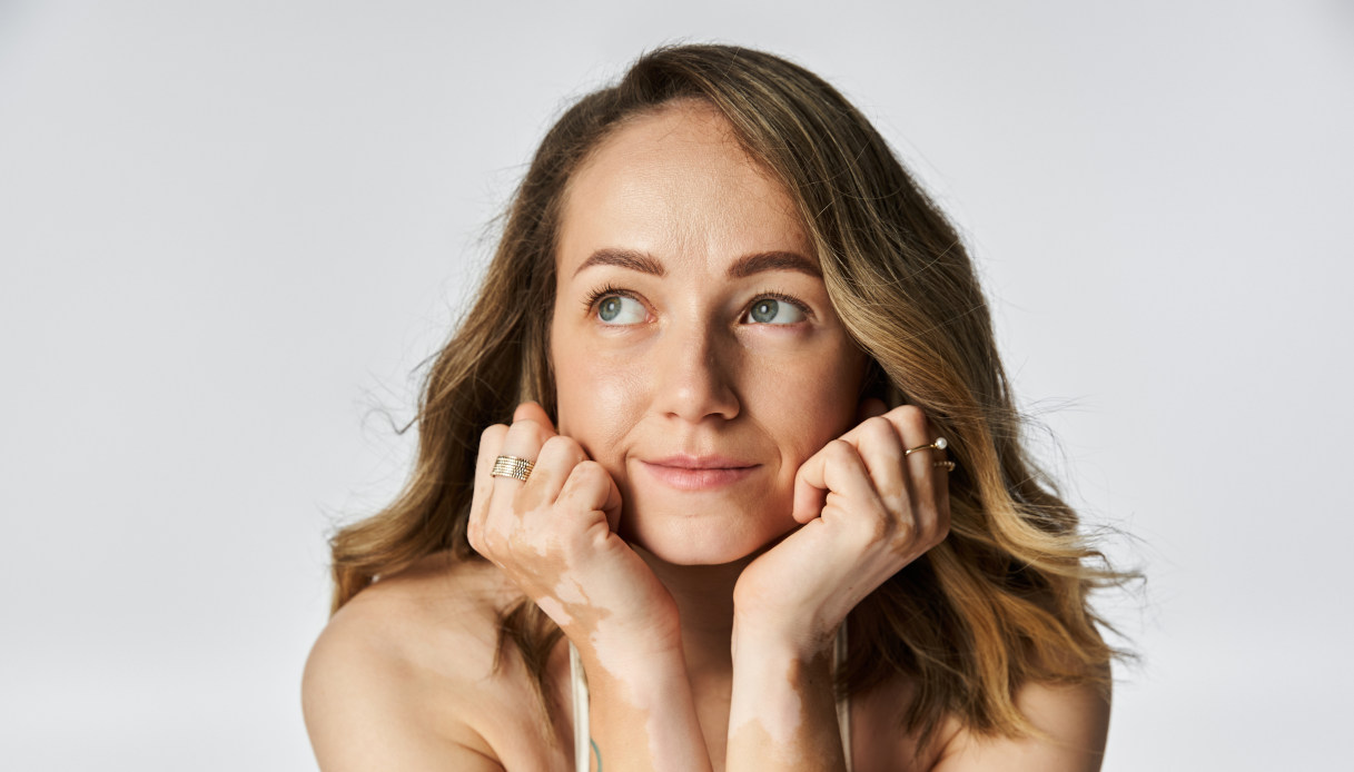 Vitiligo: vivre ensemble et aller au-delà des lieux communs