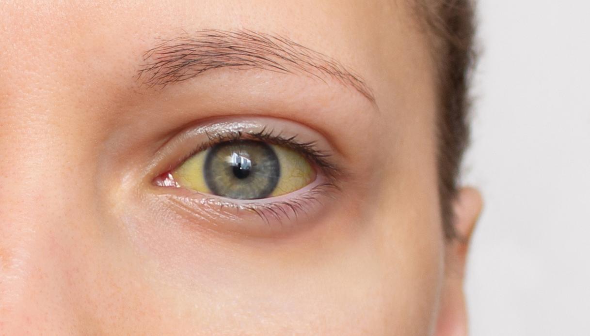 Nutrition et syndrome de Gilbert : mythes à dissiper et régime alimentaire recommandé