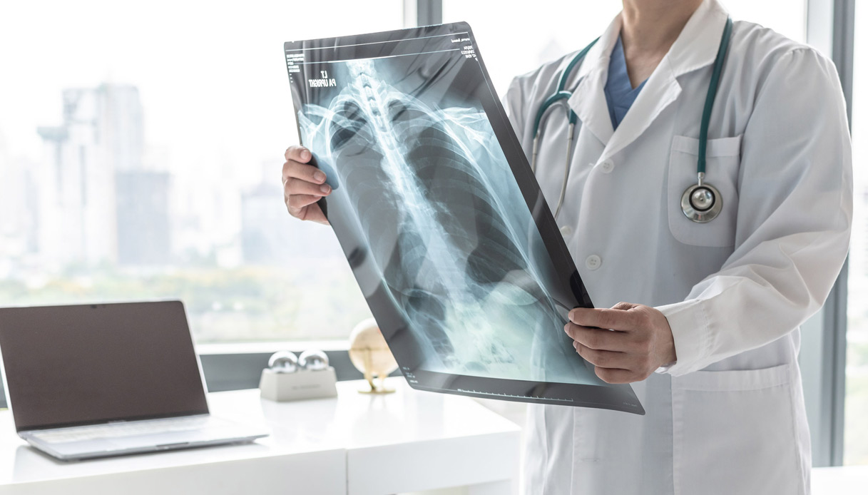 Le diagnostic précoce, un objectif clé pour mieux traiter le cancer du poumon