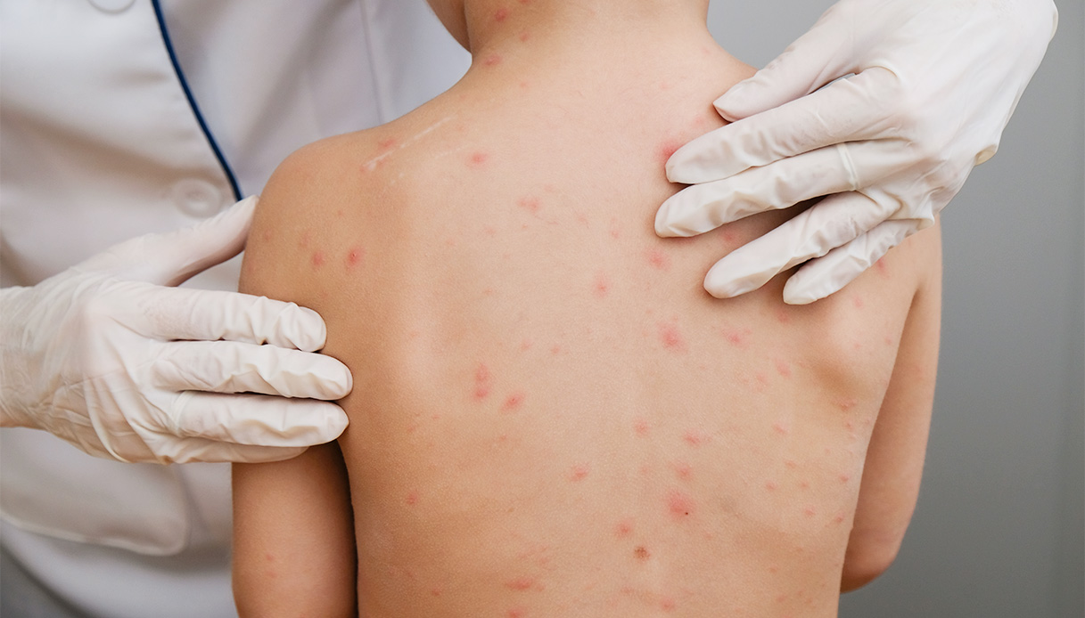 Rougeole : quels sont les symptômes et la propagation en Italie aujourd'hui