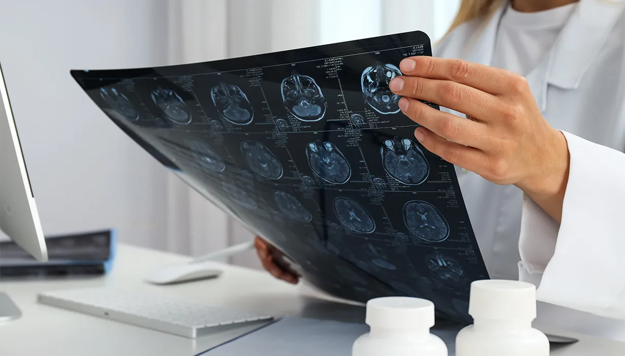 Glioblastome, comment il se manifeste et comment traiter ce type de tumeur cérébrale